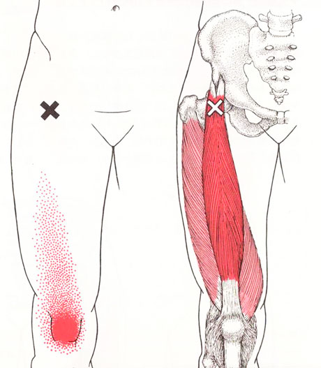 大腿直筋のTP図